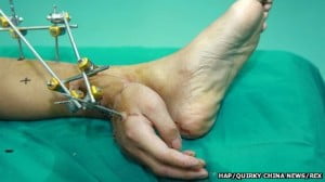 Logran salvar una mano implantándola en un tobillo.