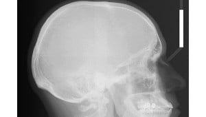 Una sexagenaria china vivió ocho meses con un palo de bambú en la cabeza.