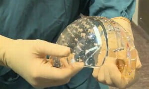 Implantado con éxito un cráneo de plástico hecho con una impresora 3D