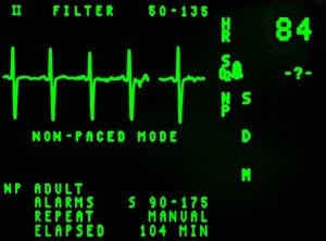 electrocardiograma